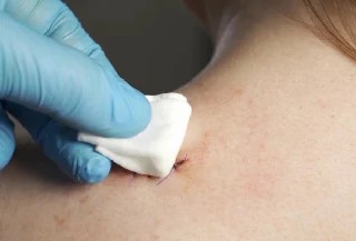 Curso Online Básico em Curativos e Feridas